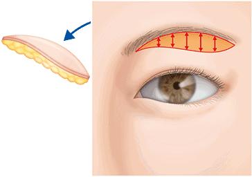 提眉术加开眼角,泡泡眼提眉术
