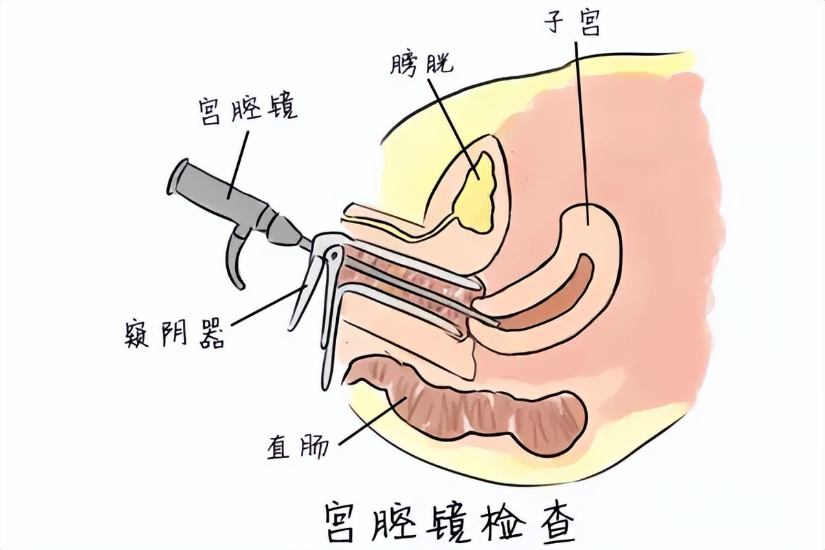 女子检查身体发现自己有两个子宫,女子查出有两个子宫