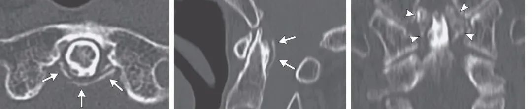 颈长肌腱炎影像表现,三头肌钙化性肌腱炎治疗