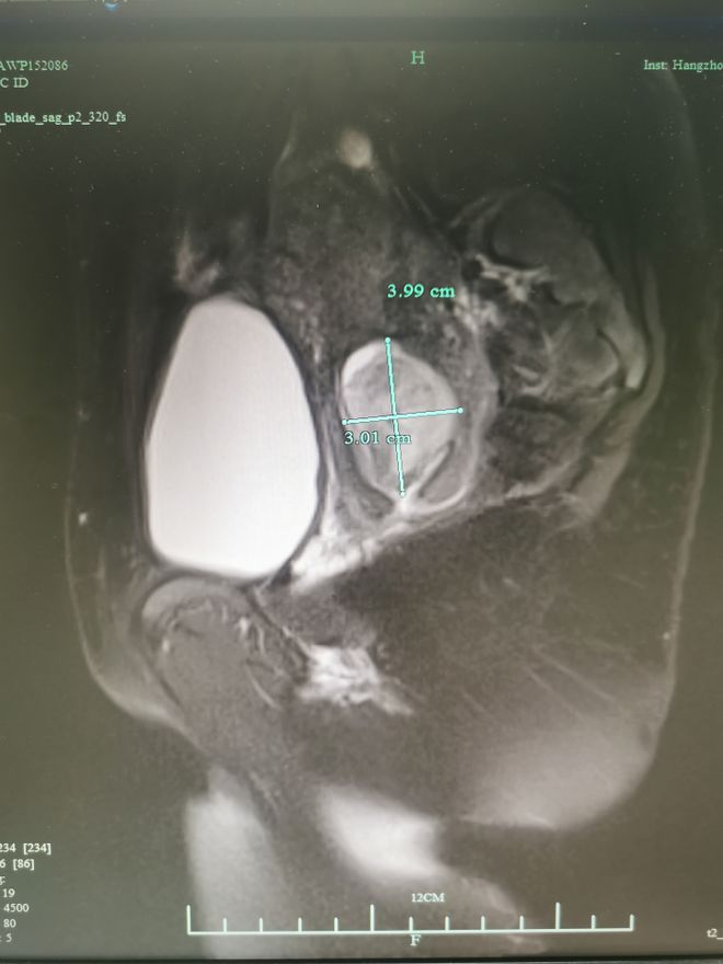 河南23岁宝妈大出血,28岁宝妈吃鸡蛋吃出宫颈癌