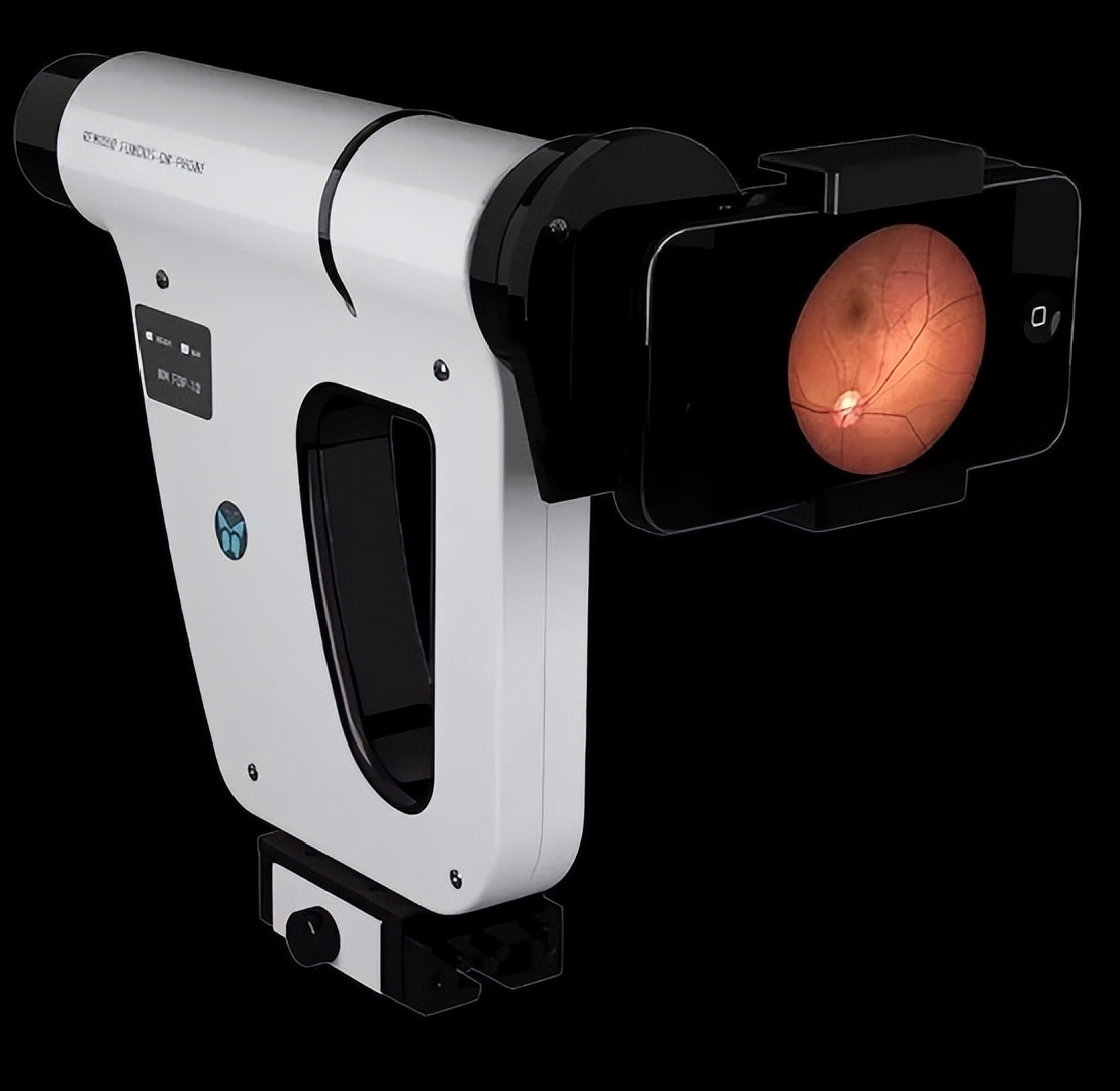 Remidio：手机+AI也能成为医疗器械潜力股｜前哨