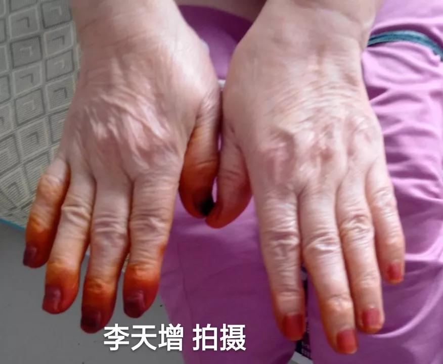 40岁女性手背开始很多皱纹怎么办,手背皮肤松弛皱纹多粗糙是啥原因