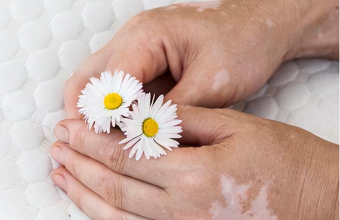 他克莫司对治疗白癜风有效吗,他克莫司治白癜风有效吗