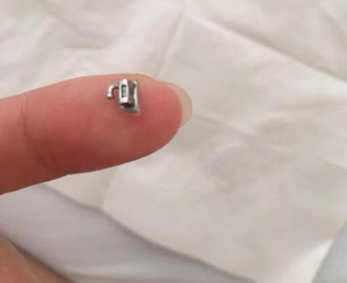 明明很小心，为什么托槽还是老掉？专家分析：问题出在这