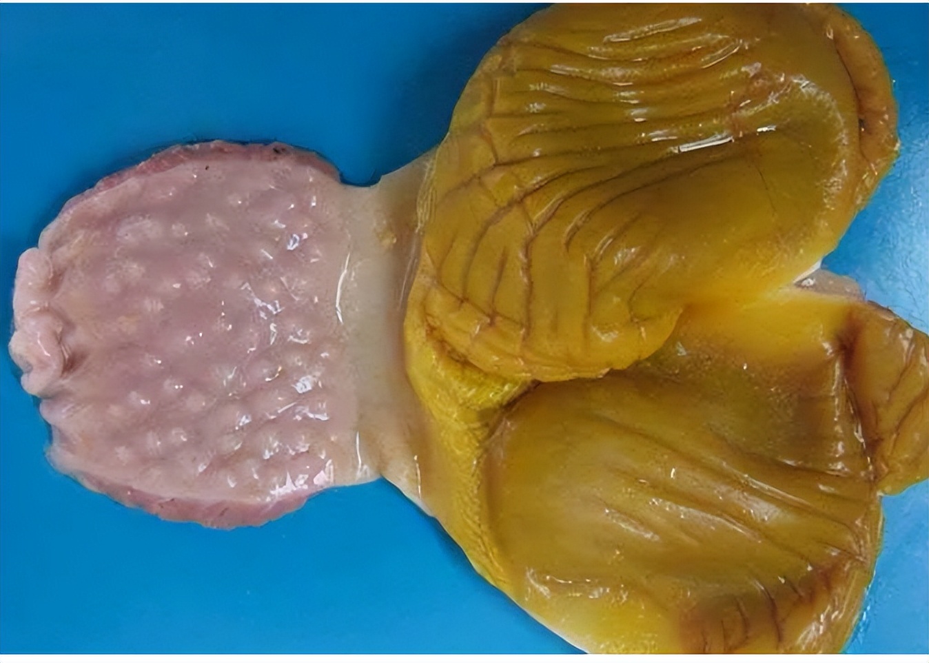 肉鸡腺胃炎喝青霉素行吗,治疗肉鸡腺胃炎中药配方