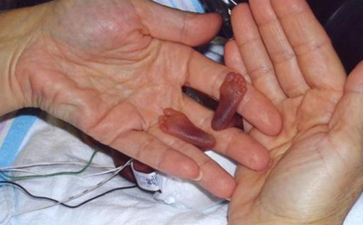 拇指姑娘出生时只有10公分,拇指姑娘出生时仅280克长大