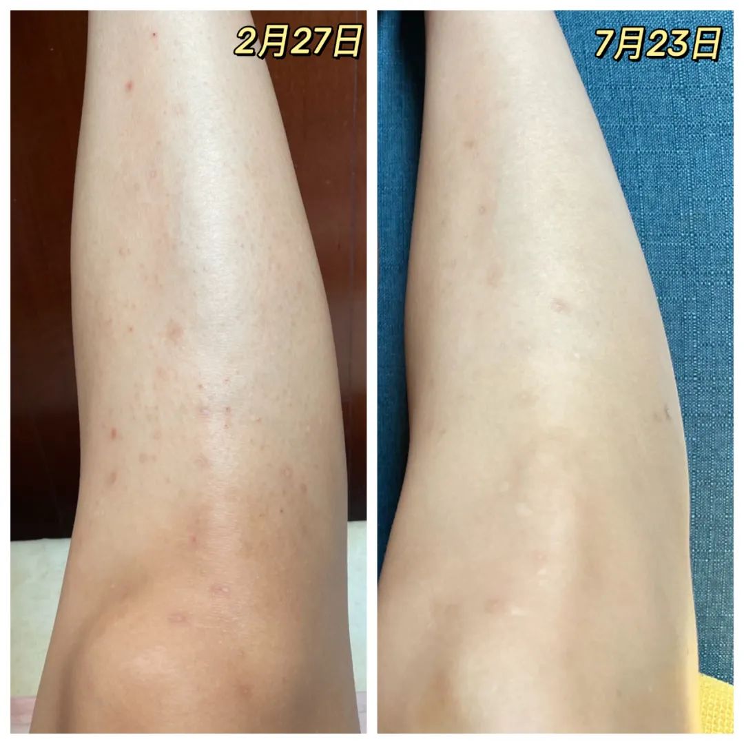 暑假一个月黄黑皮如何美白,天生黑皮的美白项目