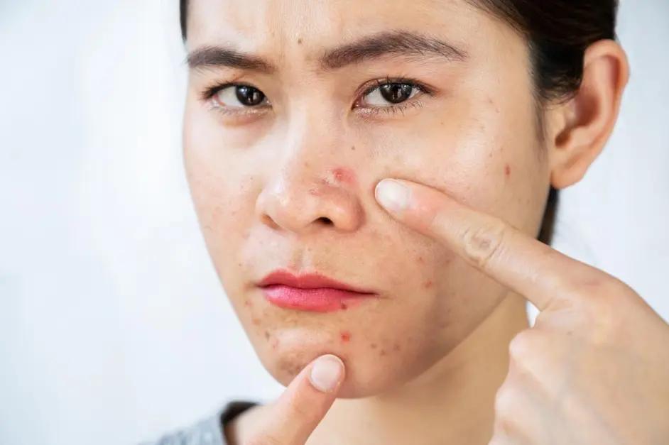 u牌护肤品对痘痘有用吗,u牌化妆品能祛痘吗