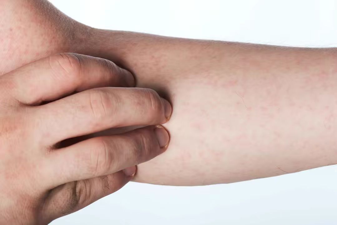 秋季皮肤痒起丘疹,皮肤瘙痒起小红疙瘩警惕4种疾病