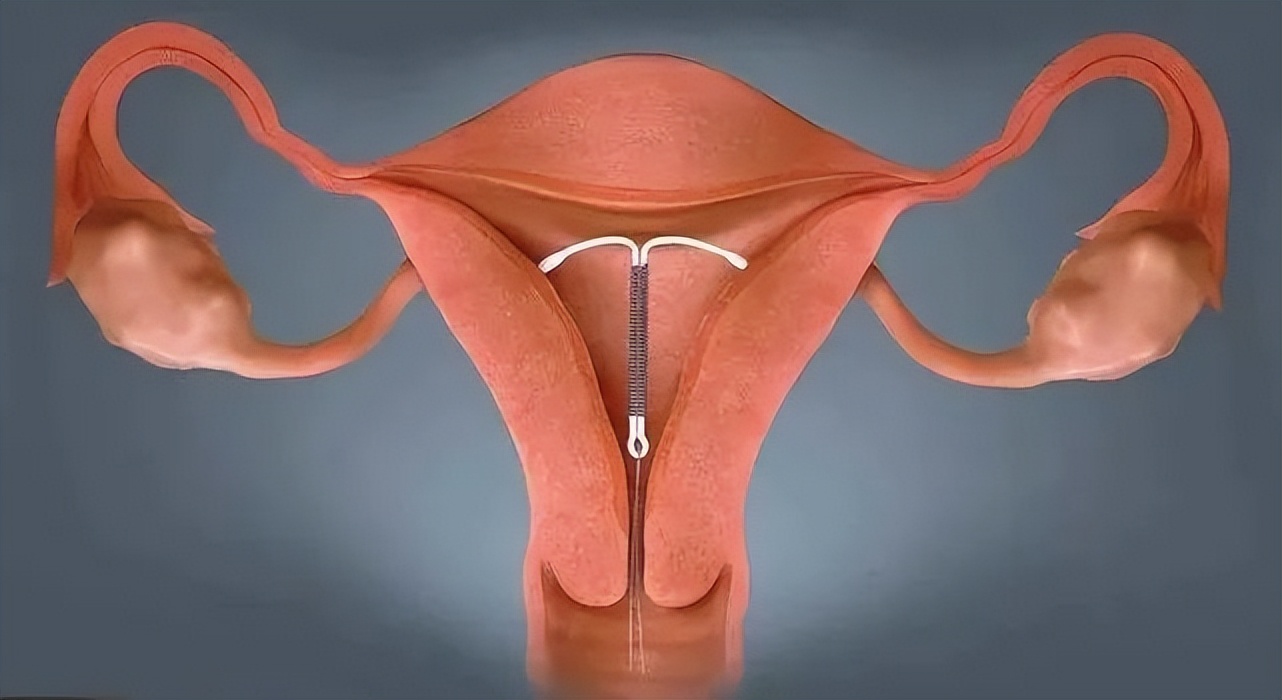 医生放环直接能看到子宫里环吗,医生把纱布缝病人肚子里