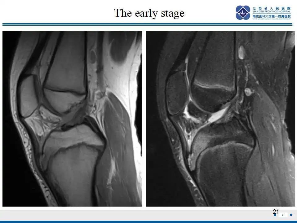 胫骨结节软骨炎要怎么治疗,胫骨结节骨软骨炎会癌变吗