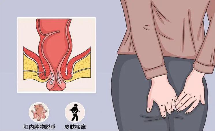 肛内尖锐性湿疣激光后怎么处理,肛内尖锐性湿疣激光后吃什么药