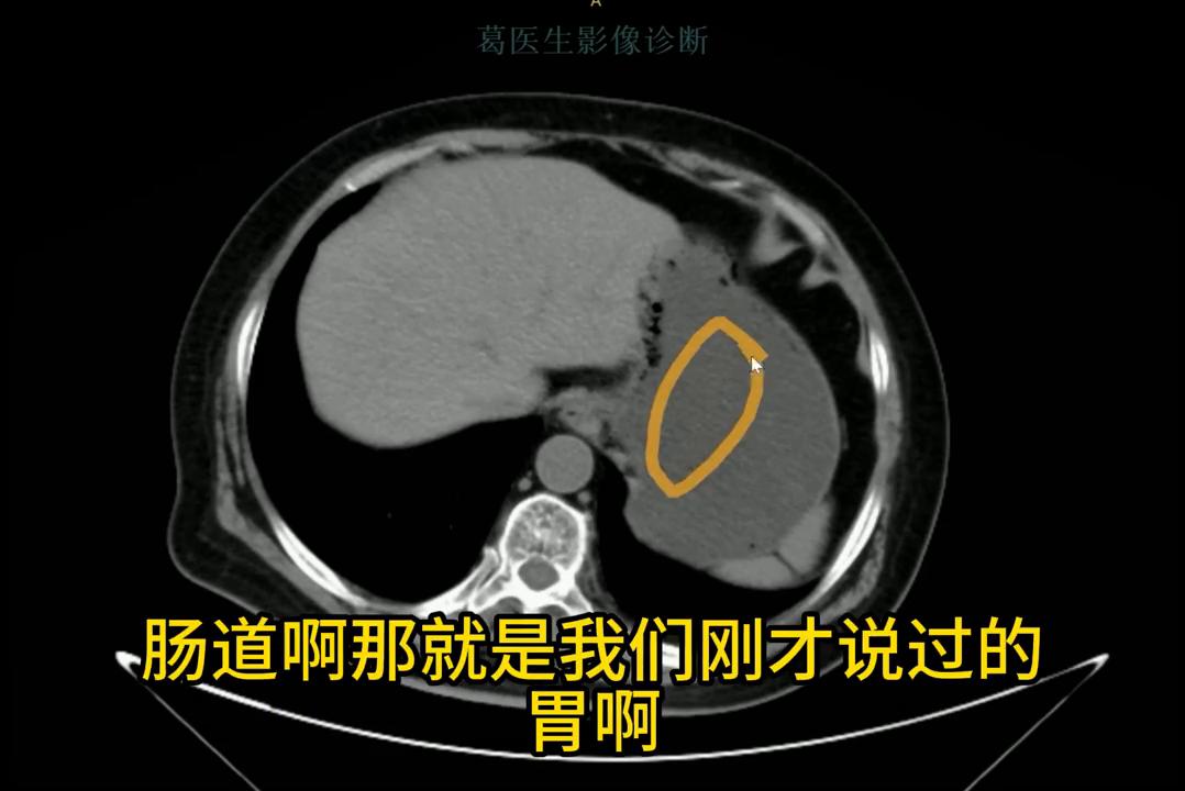腹部ct影像解剖图谱,腹部ct阑尾影像