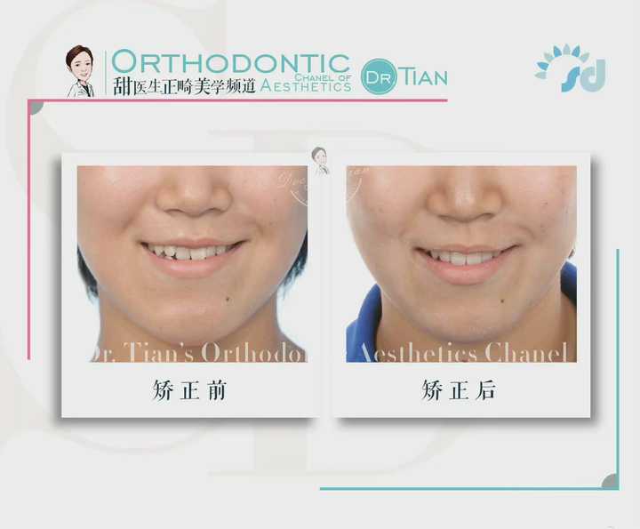 大小脸不对称改善,左右大小脸能矫正吗