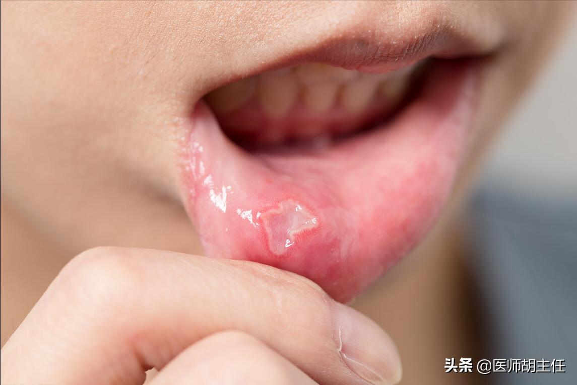 得了口腔溃疡怎么缓解疼痛更有效,口腔溃疡太疼了有啥偏方