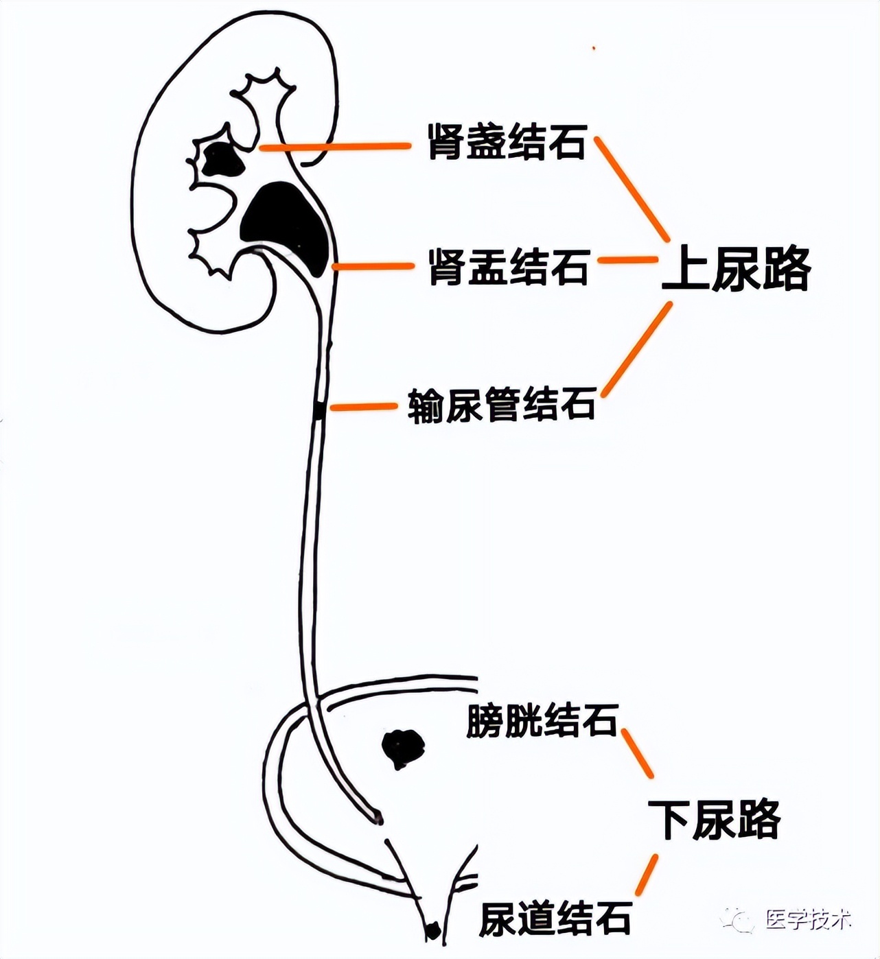 泌尿系结石最好的治疗方法,泌尿系结石最佳治疗方法