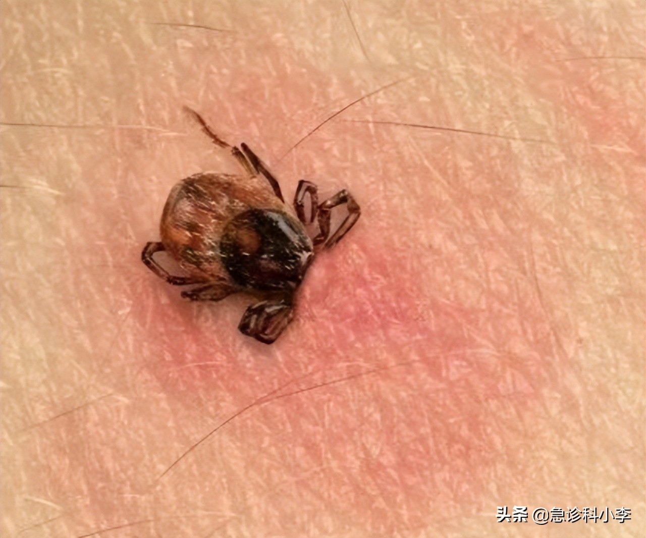 蜱虫咬人死亡率多少,蜱虫咬后死亡率新闻
