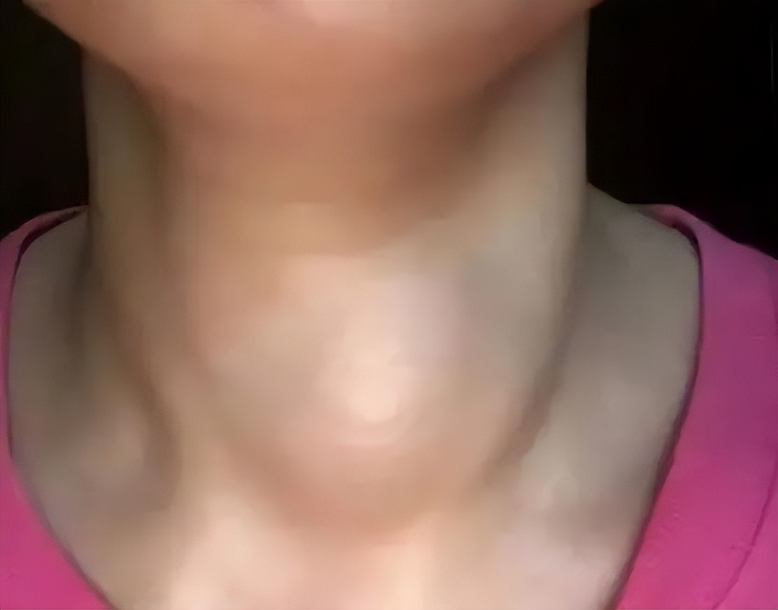 喉咙老是有痰与甲状腺结节有关吗,咽喉有吐不完的粘痰怎么治疗