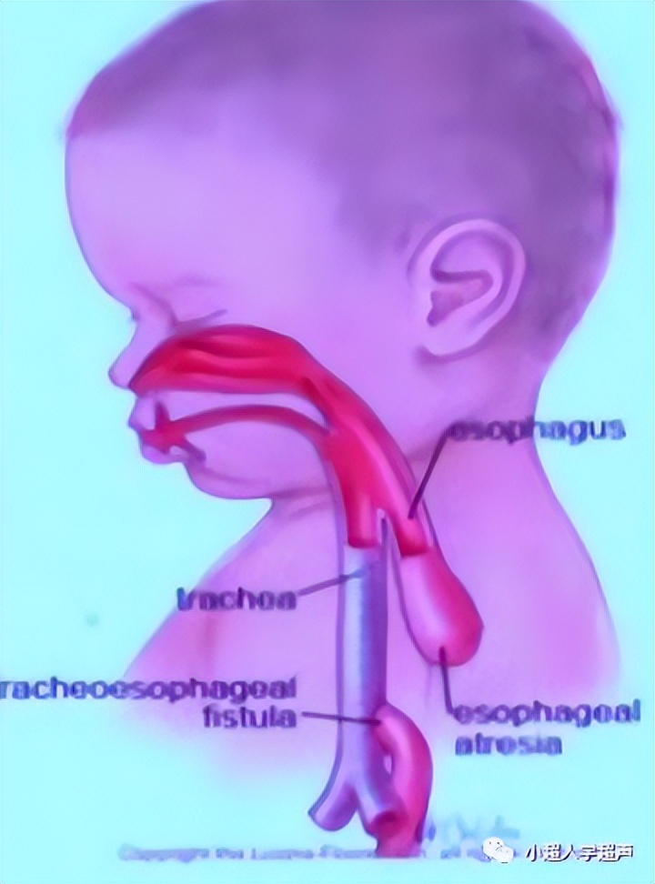 食道闭锁超声表现,食管闭锁一型手术过程