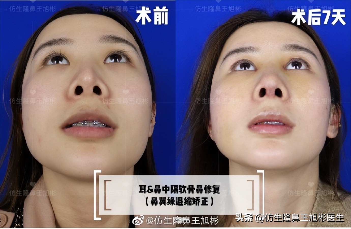 假体隆鼻耳软骨垫鼻尖图片,l型假体耳软骨隆鼻图片