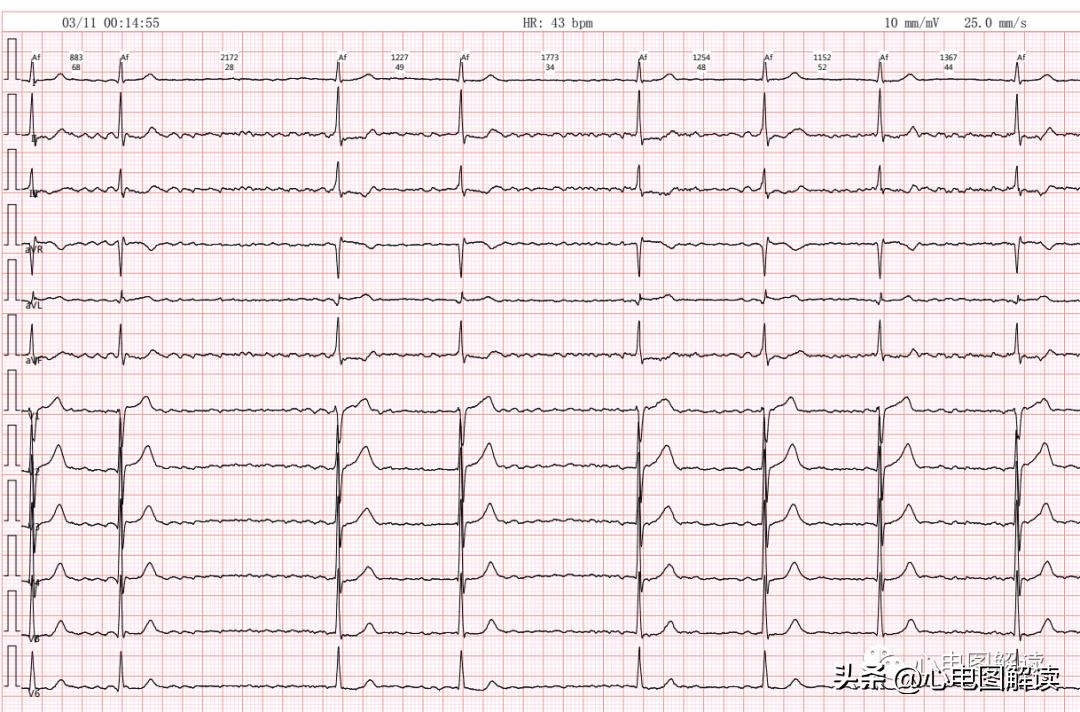 心房颤动伴长间歇心电图,心房颤动伴长间歇是什么意思