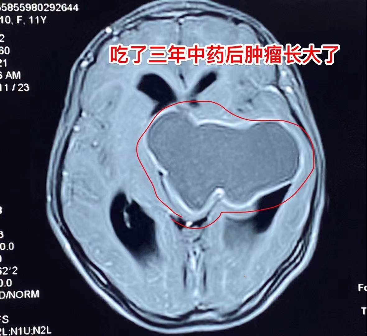 误区！吃中药能控制颅咽管瘤！颅咽管瘤最有效的治疗是手术
