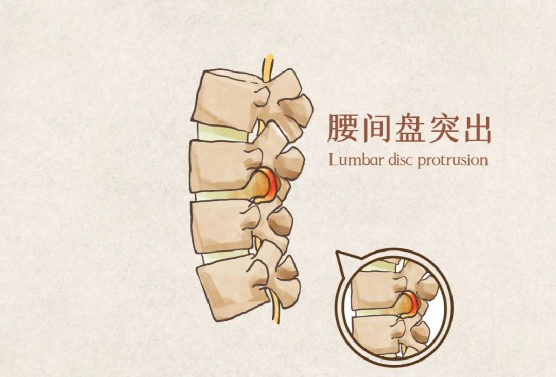 腰椎康复在家自我疗法,腰椎微创康复