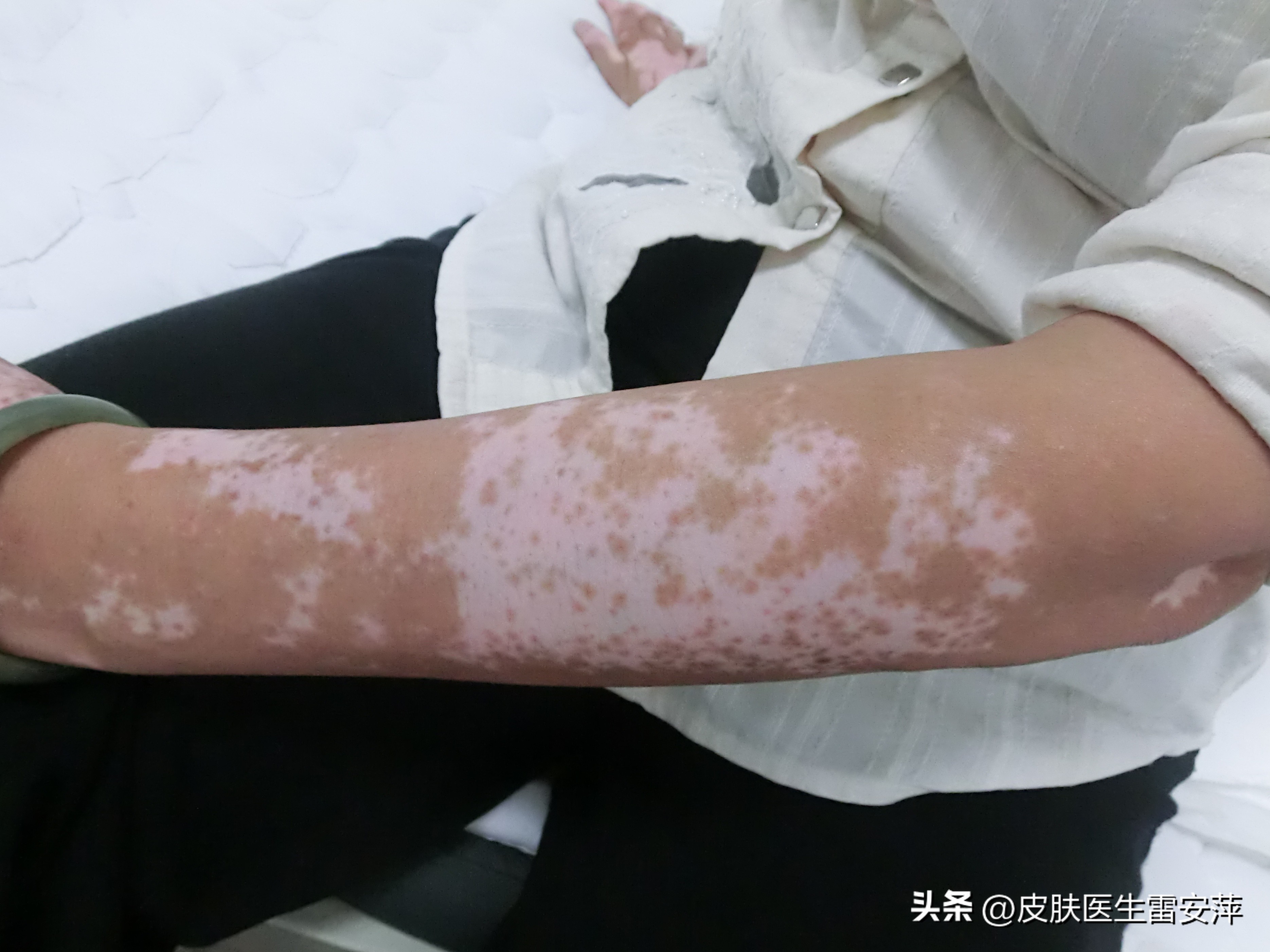 皮肤上突然黄了一块,突然有块地方变白是白癜风吗