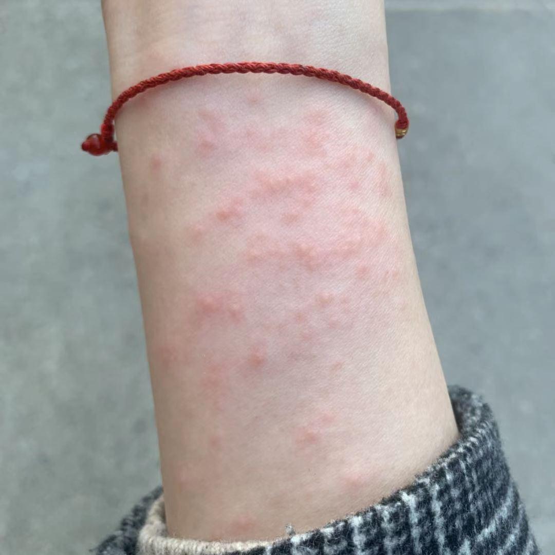 对镍过敏是怎么回事,镍过敏的人多不多