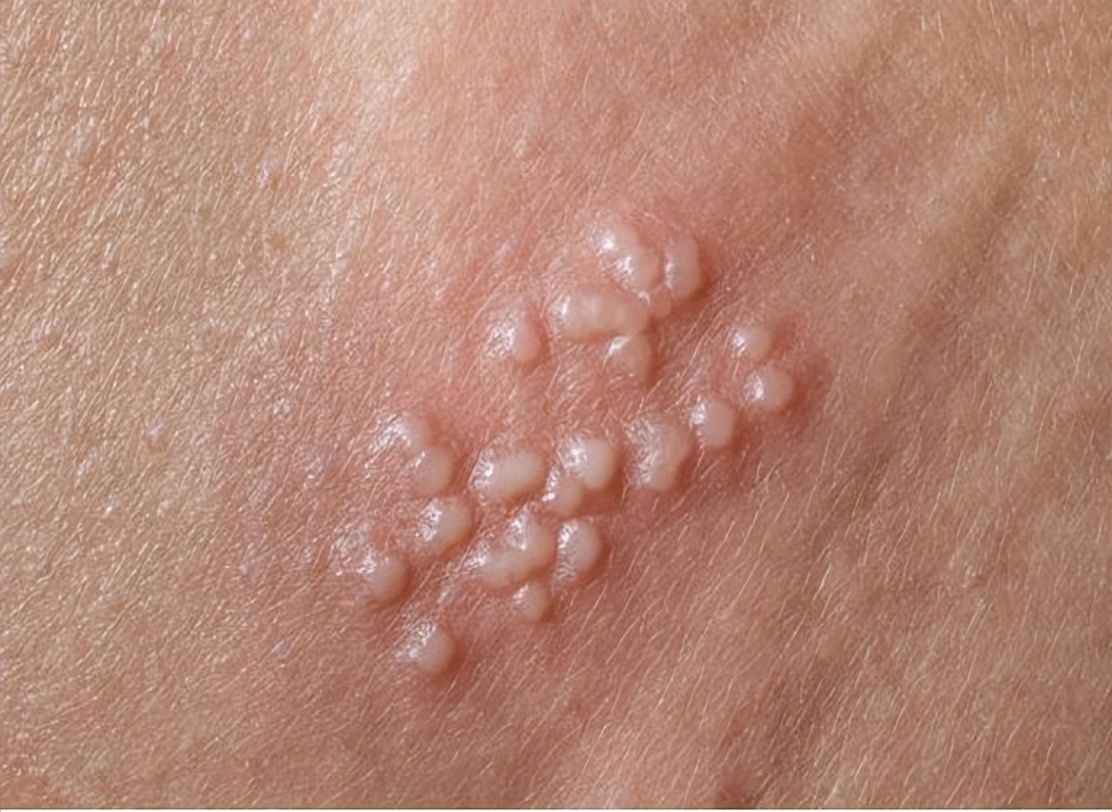 男女都正常怎么会感染hpv,hpv男女谁传染的机会大些