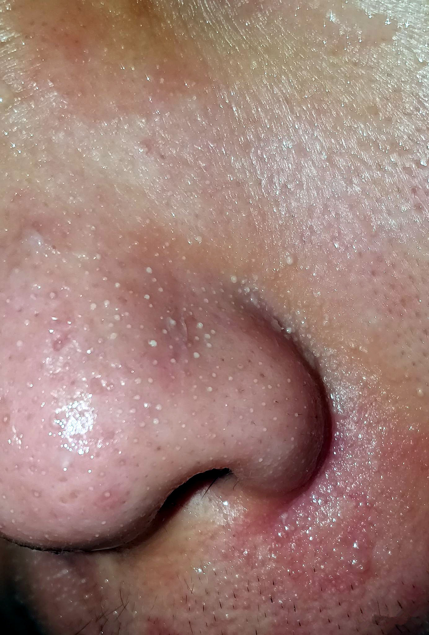 眉心鼻翼和下巴长粉刺为什么,鼻头上起粉刺什么原因引起的图片