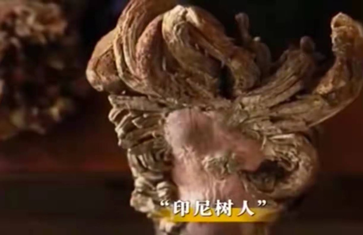 男子手长满树疙瘩是什么病,男子手长满树疙瘩手术了吗