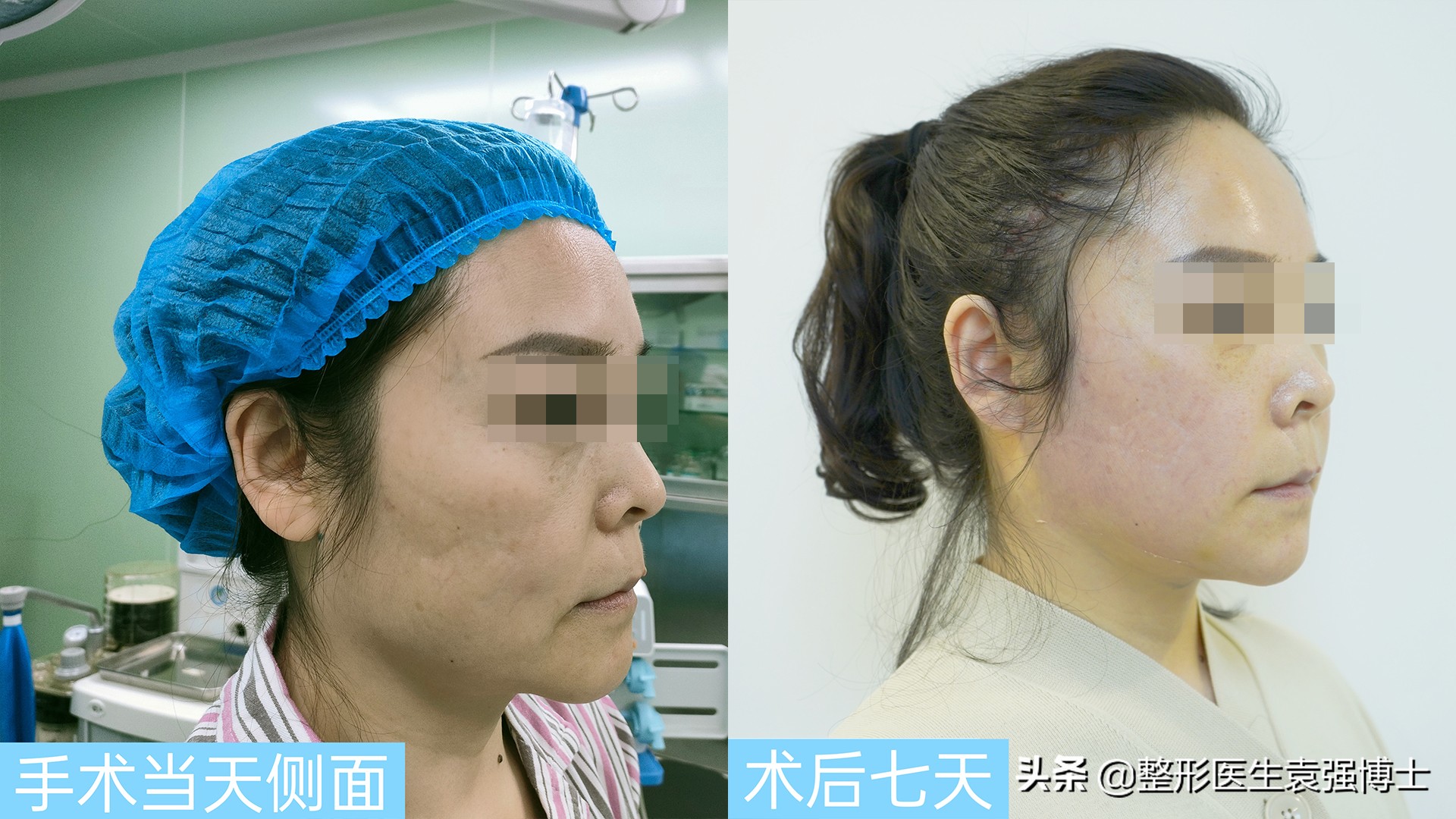 拉皮手术那么危险为什么还有人做,拉皮手术的真实感言