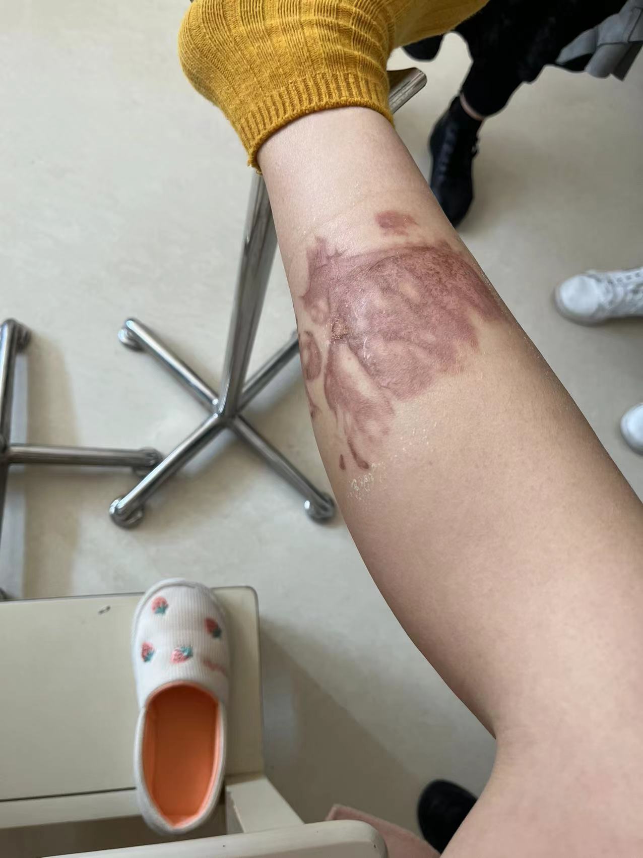 滚烫茶水泼身！双下肢4%二度烫伤！沪上月子会所内，二宝妈痛痛痛