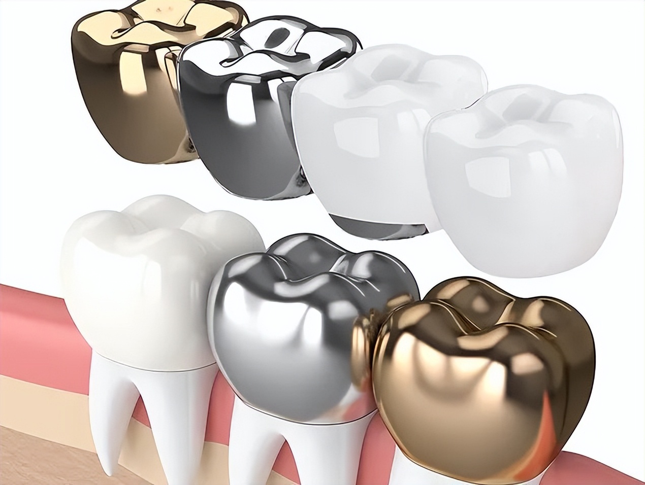 无铍烤瓷牙与普通烤瓷牙区别,医院的烤瓷牙和牙科诊所有区别吗