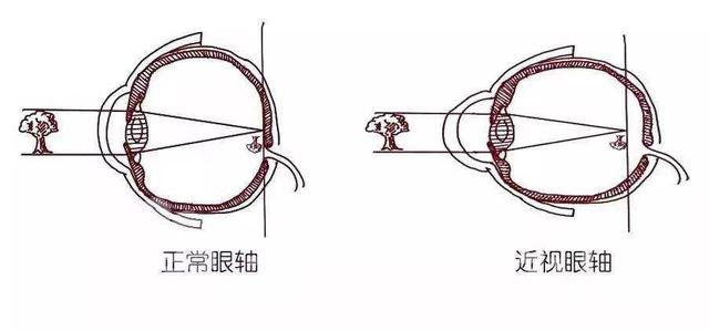 检查结果显示孩子眼轴长了，有办法改变吗？