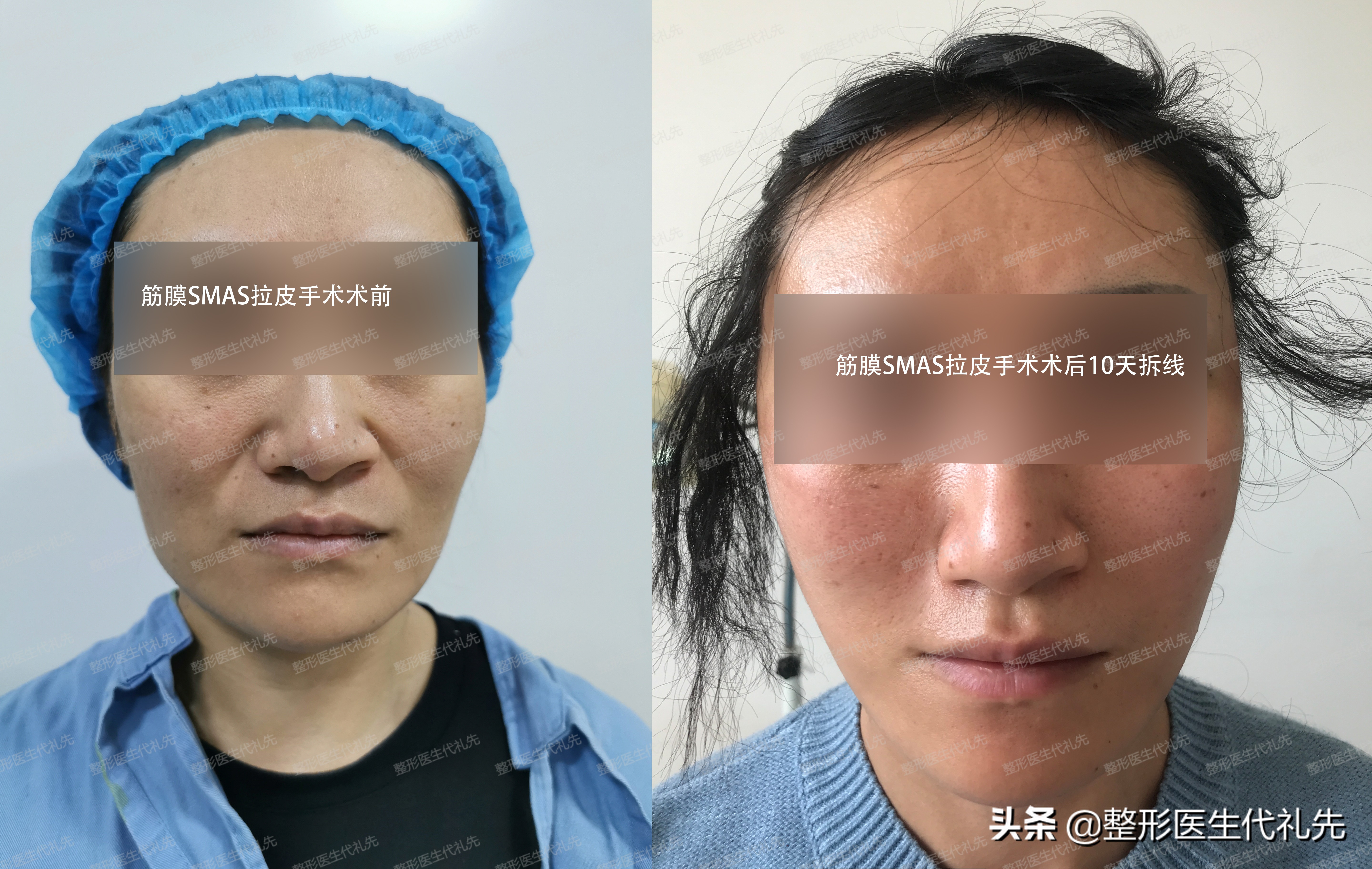 有法令纹最好的解决办法真实有效,法令纹严重最有效的办法