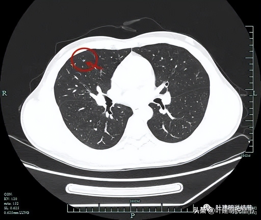中叶多发微小结节,男性30岁右侧甲状腺单发结节
