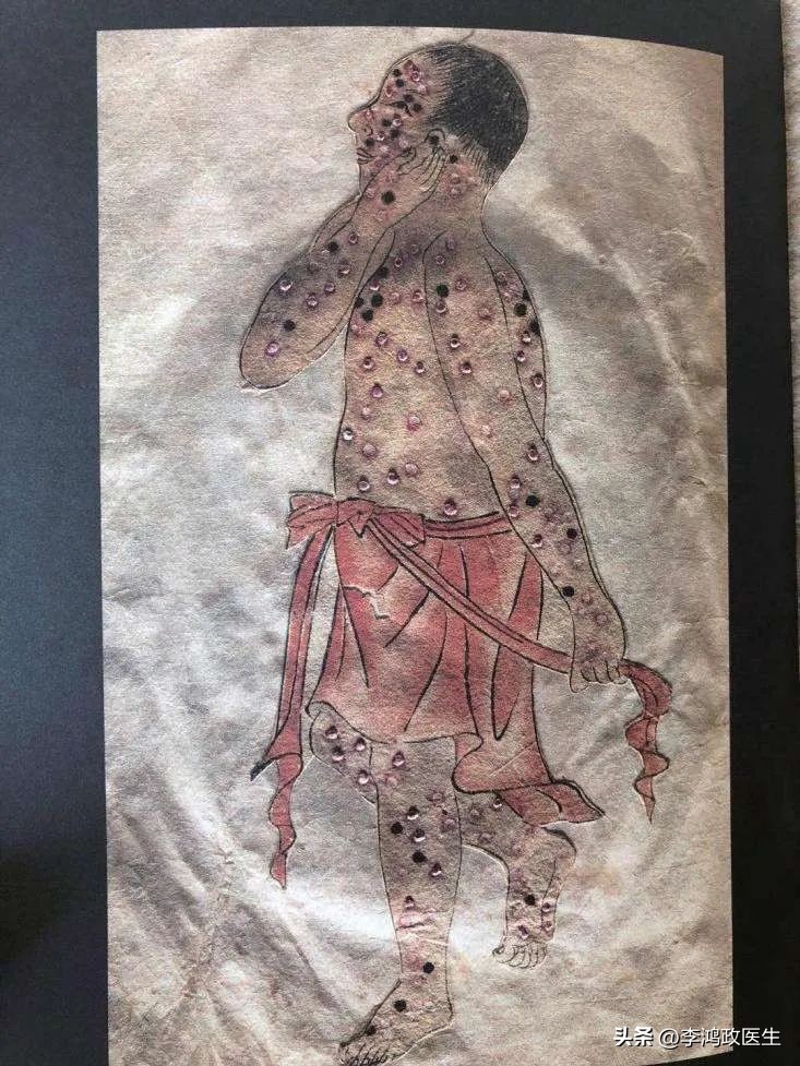 天花病为什么奇迹般消失了,对天花没有免疫力