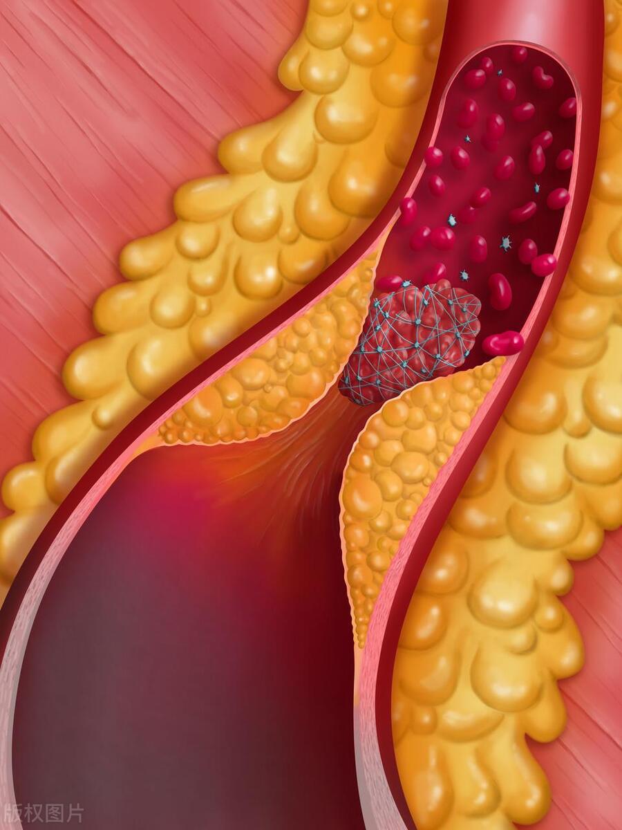 左腿静脉血栓是怎么回事,左腿静脉血栓是什么原因引起的