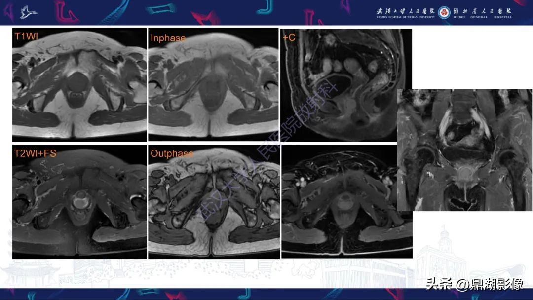 阴道里长肉瘤是啥症状,阴道肉瘤症状