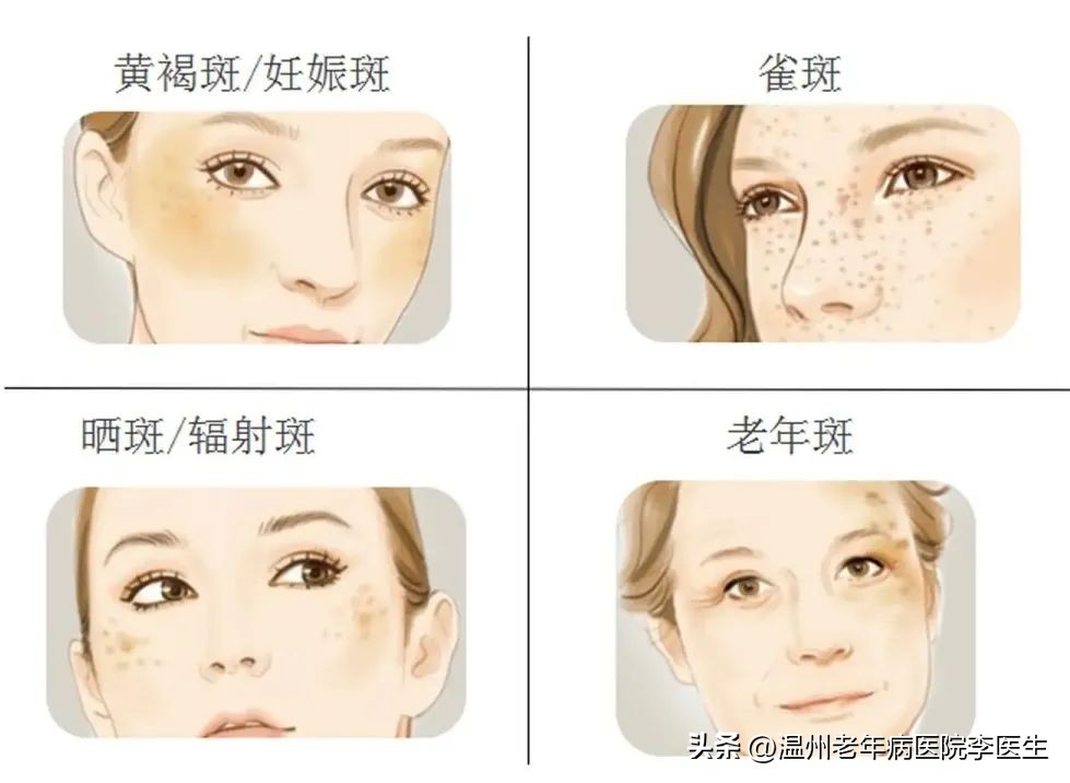 光子嫩肤真的嫩肤吗,美白嫩肤光子