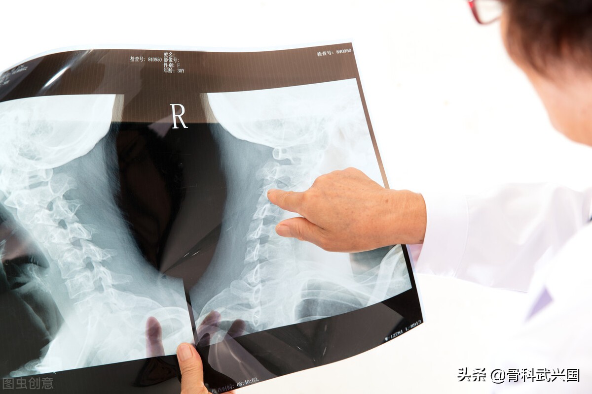 治疗脚后跟骨刺最直接有效的方法,脚长骨刺最好的治疗方法如下