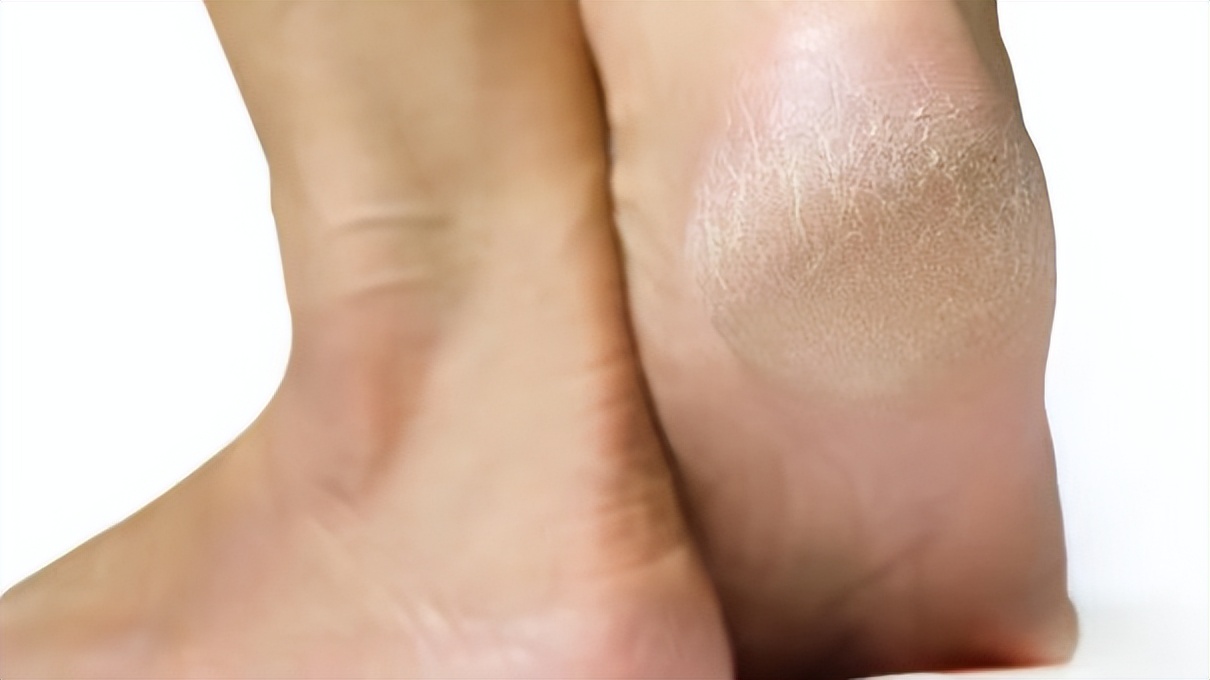 脚后跟干裂可能与这4个原因有关,脚后跟总干裂原来是这3个原因