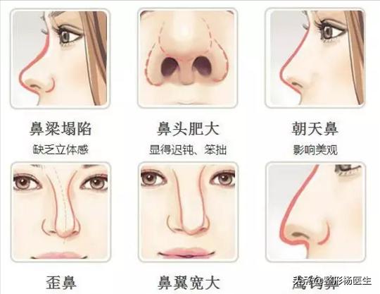 隆鼻怎么做才自然又安全,隆鼻小知识视频