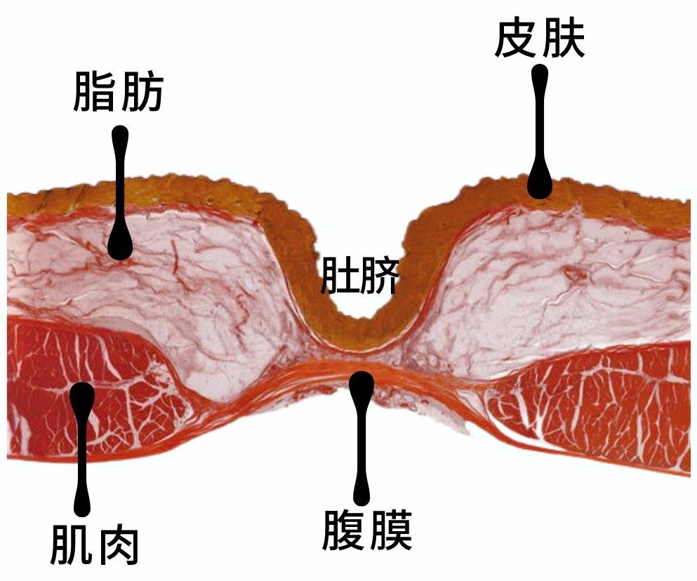 肚脐眼凸出来是脐带没剪好吗,为什么肚脐眼上面有一条凹线