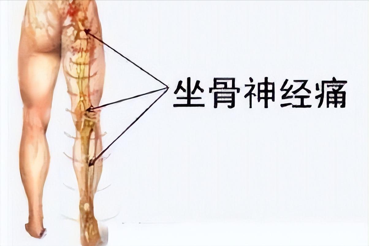 甲钴胺治疗腰椎间盘突出是神药吗 (甲钴胺片是治疗腰椎间盘突出吗)