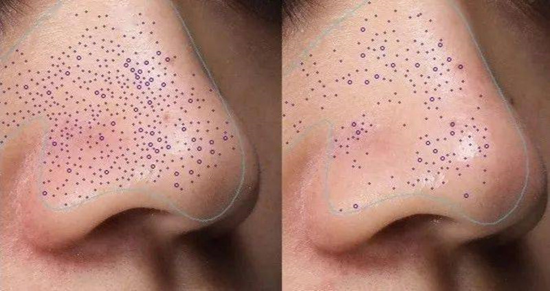 挤黑头用什么收缩或张开毛孔,挤黑头后毛孔大怎么物理修复