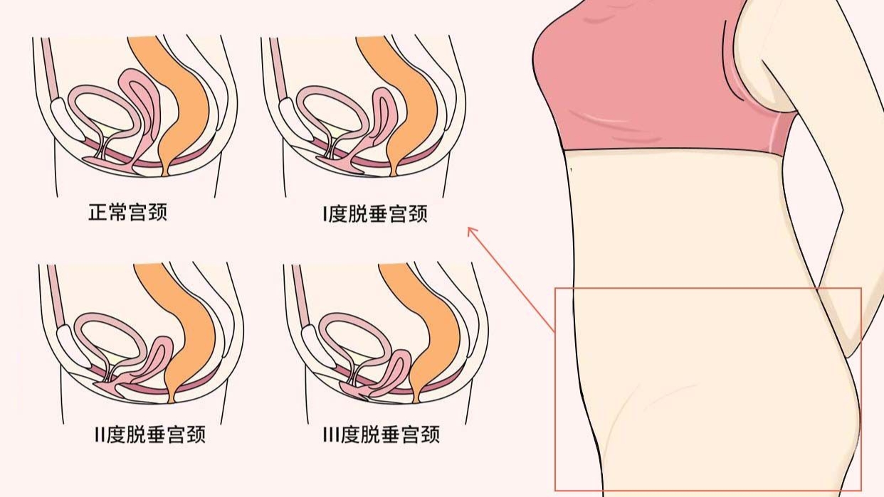 女性六十岁子宫脱垂怎么治疗,子宫脱垂一级的女性多吗