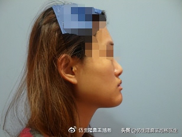 鼻基底填充会移位到鼻孔吗,鼻基底填充假体会拉长人中吗